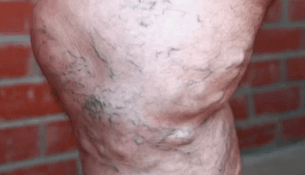 Fases do desenvolvemento de varices en homes